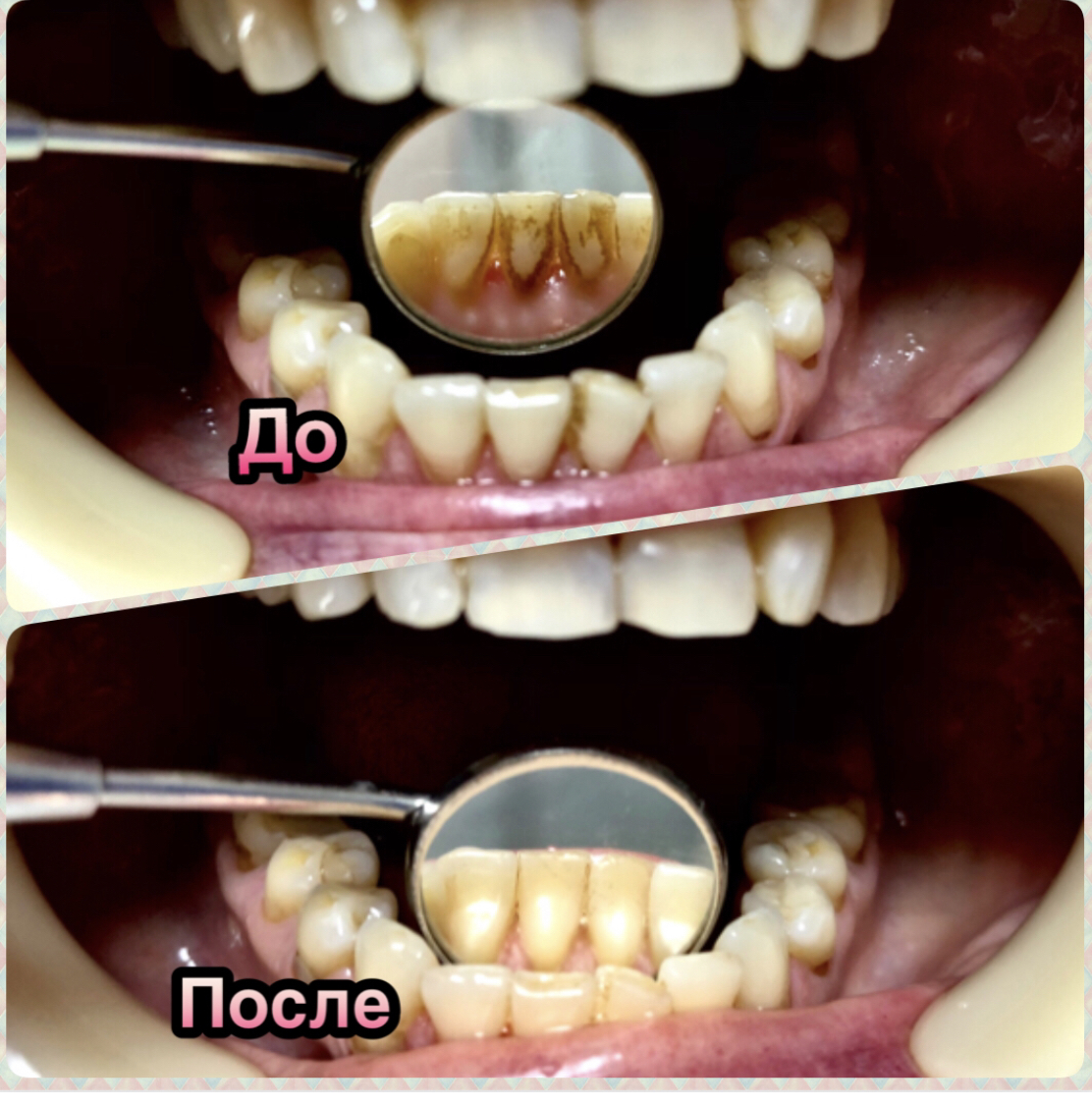 Чистка зубов с использованием ультразвука&nbsp;
